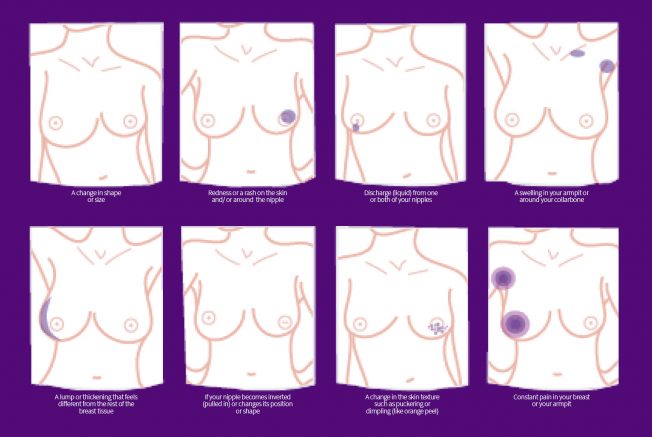 Breast Cancer Signs Chart